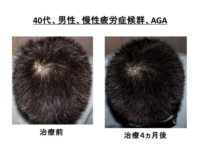 円形脱毛症　病院